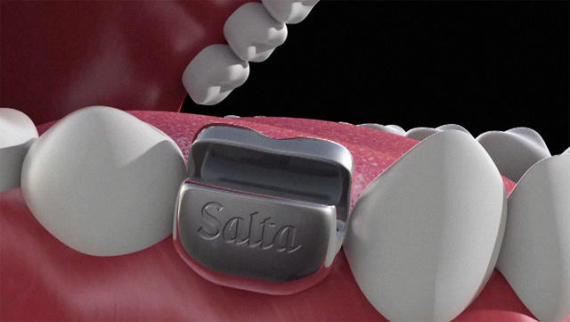 SaltaImplant